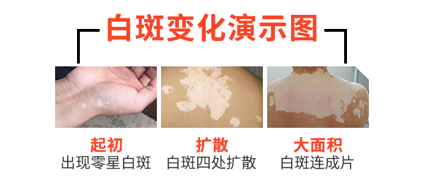 颈部白癜风有什么危害？